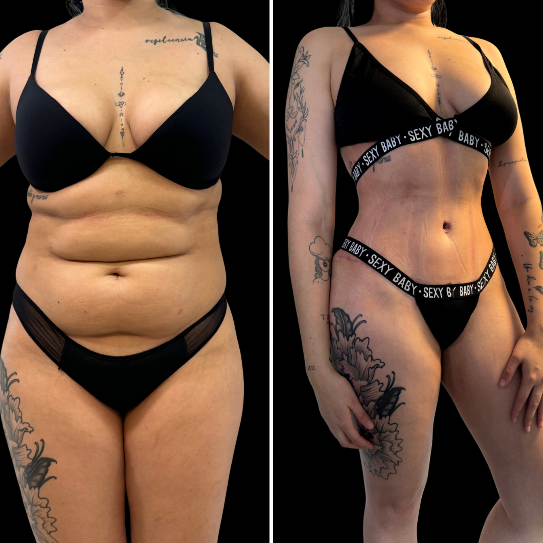 Transformación de Paciente 1