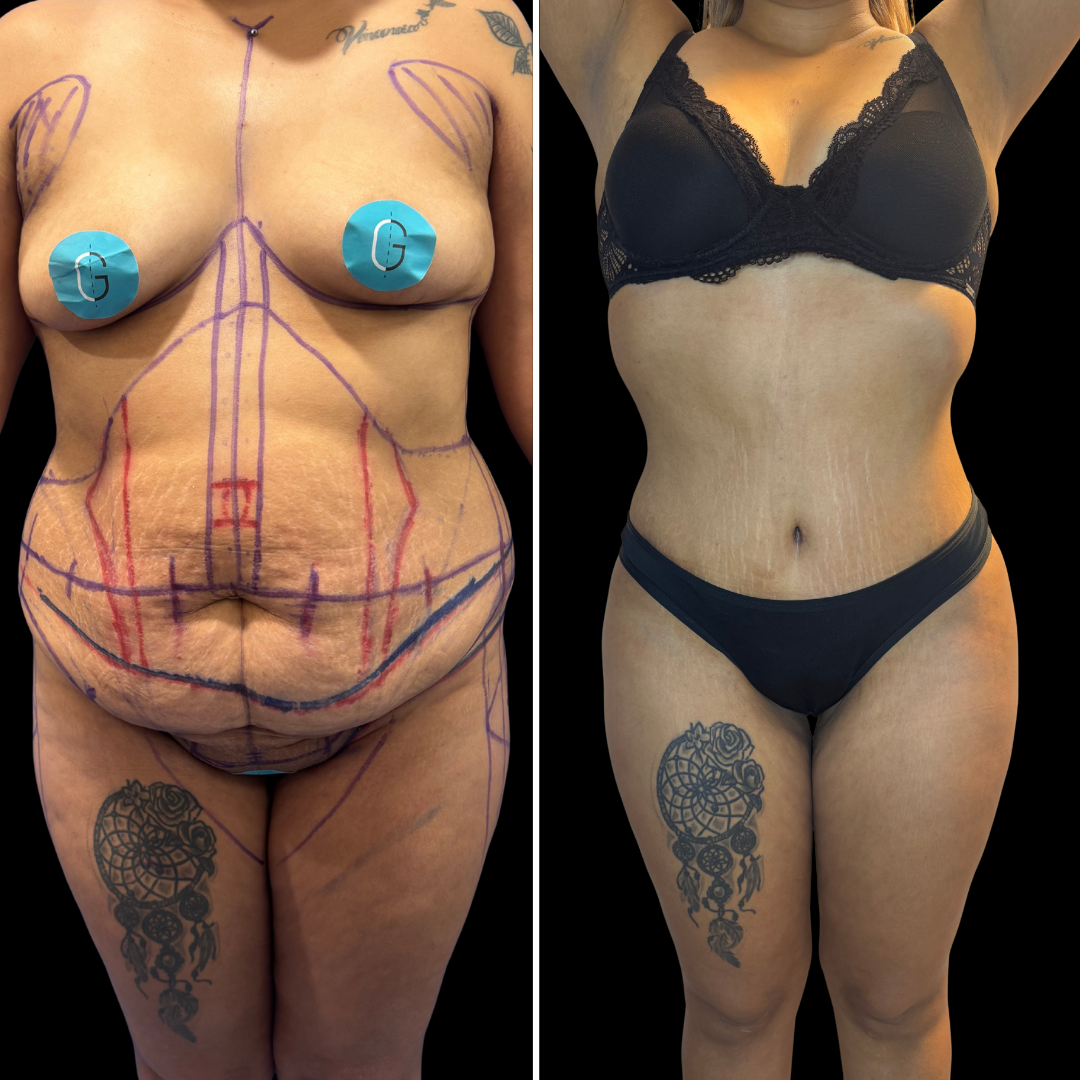 Transformación de Paciente 2