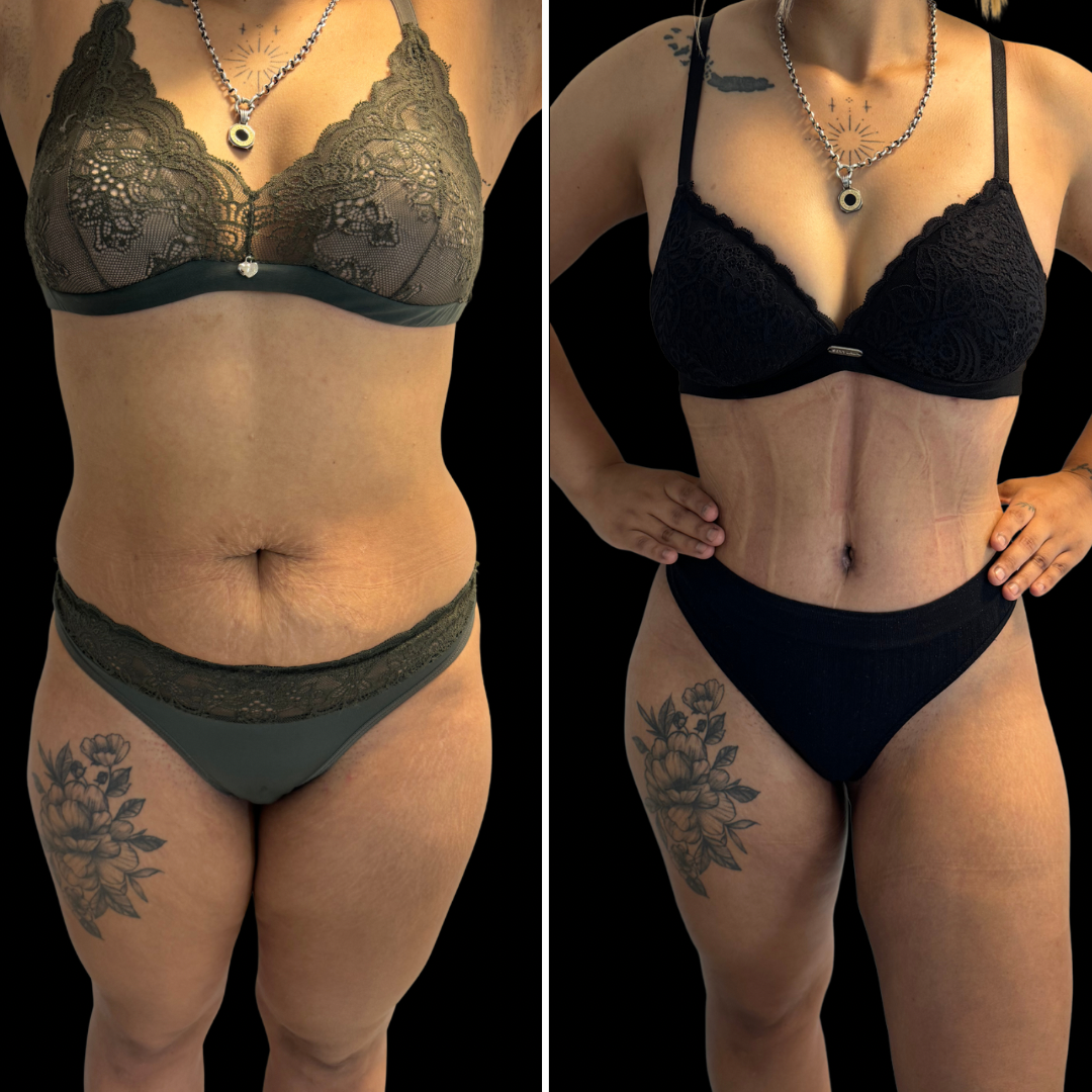 Transformación de Paciente 3