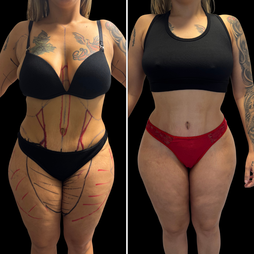 Transformación de Paciente 4